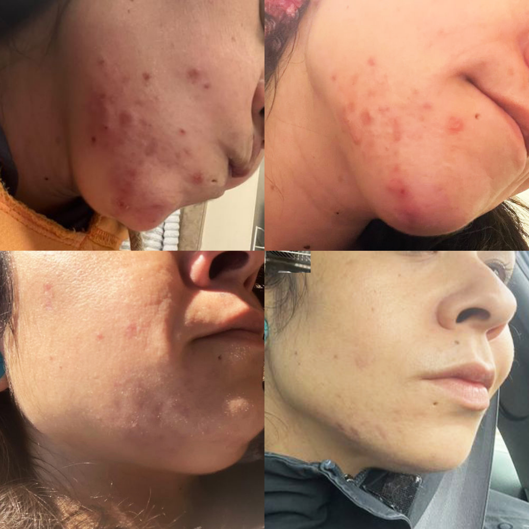 PLANT VOODOO - Clarifying Concentrate for Dehydrated Blemish Prone Skin