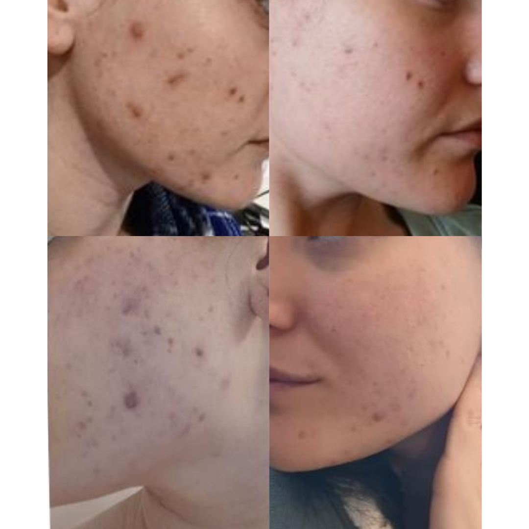 PLANT VOODOO - Clarifying Concentrate for Dehydrated Blemish Prone Skin