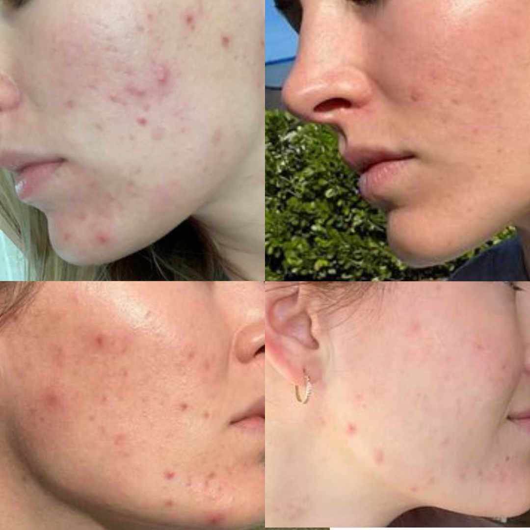 PLANT VOODOO - Clarifying Concentrate for Dehydrated Blemish Prone Skin