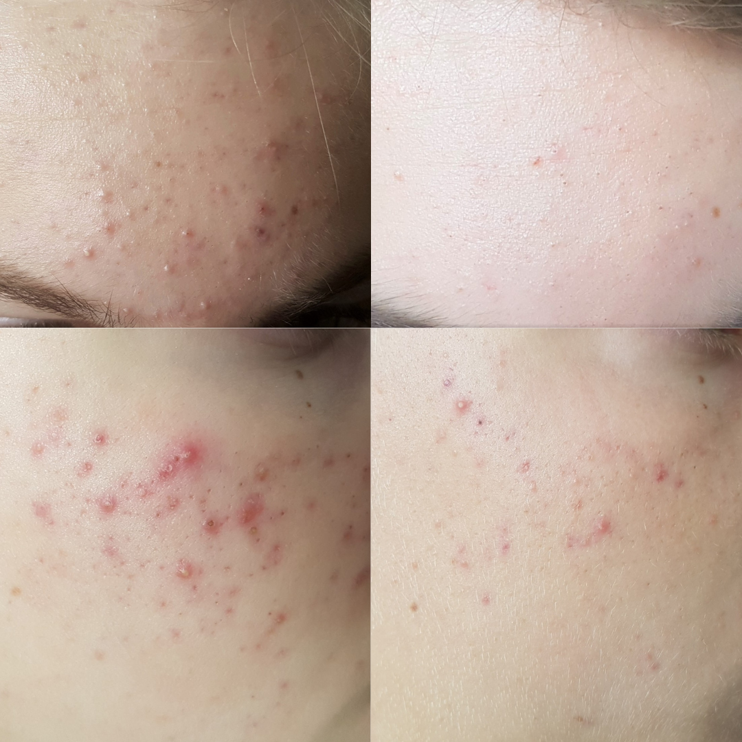 PLANT VOODOO - Clarifying Concentrate for Dehydrated Blemish Prone Skin