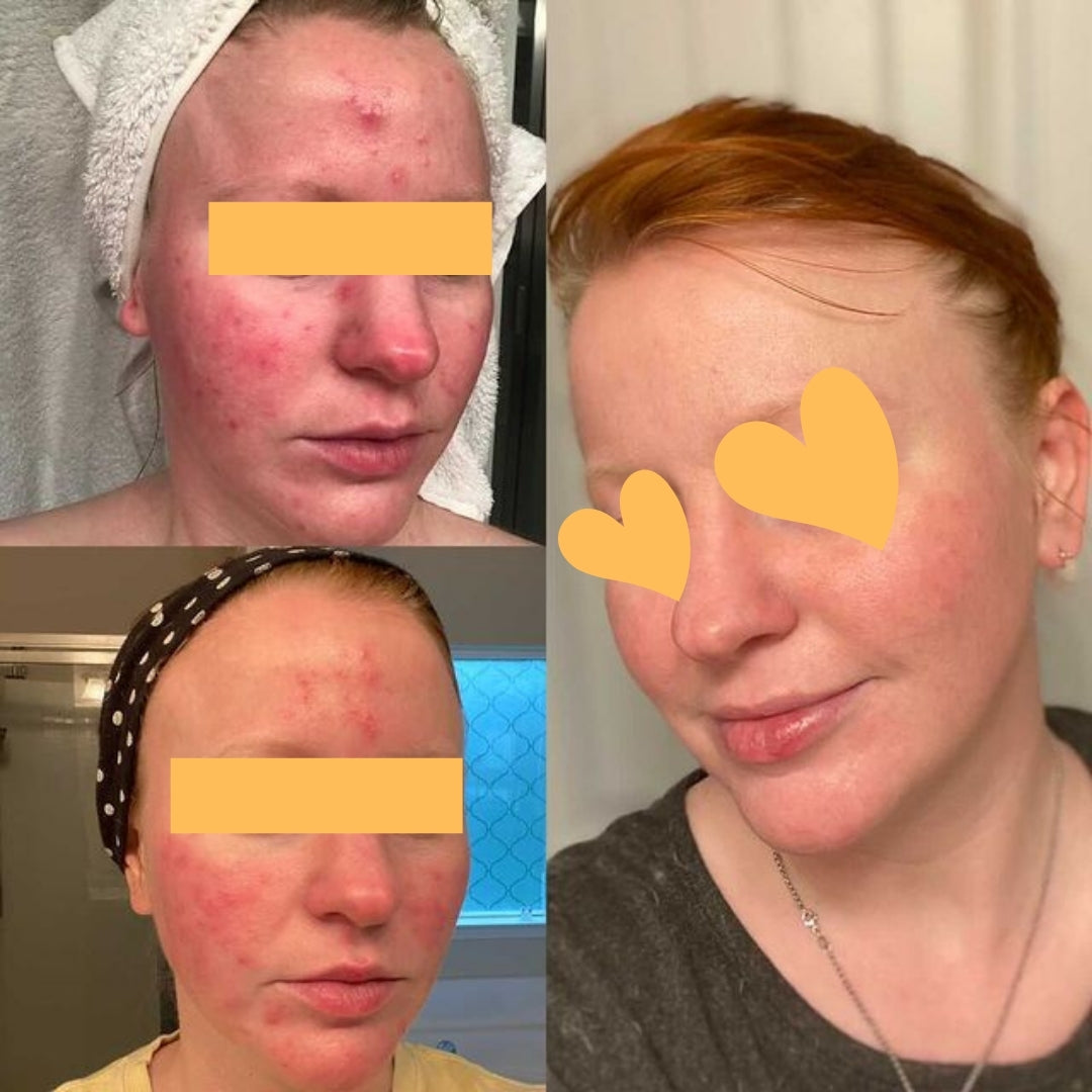 PLANT VOODOO - Clarifying Concentrate for Dehydrated Blemish Prone Skin